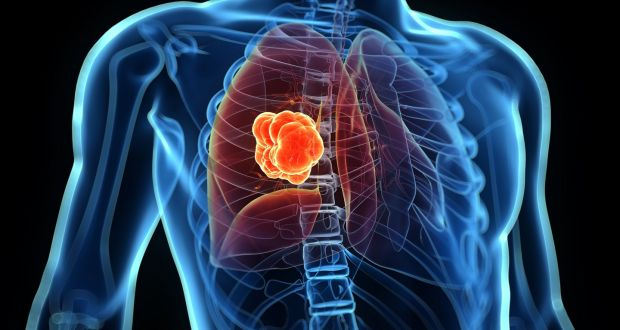 Lung Cancer; All you need to know about the disease