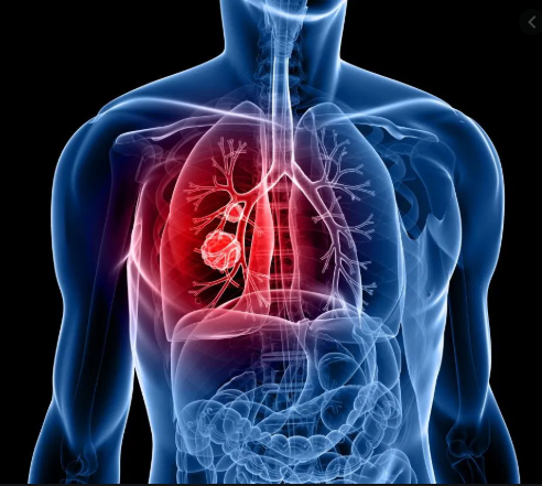 Lung Cancer