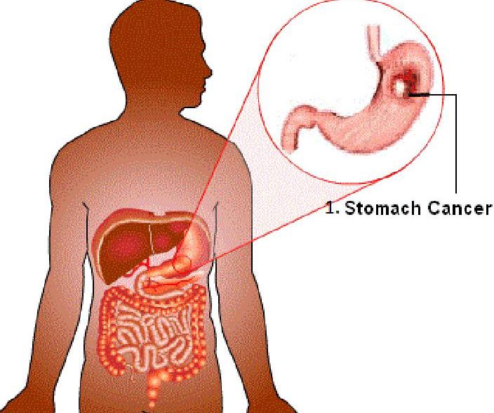 Stomach Cancer; All you need to know about the disease