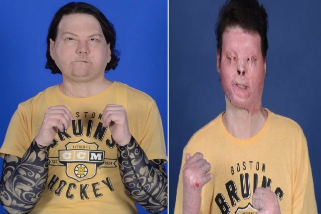 Joseph DiMeo becomes the first man to receive a successful face and hands transplants