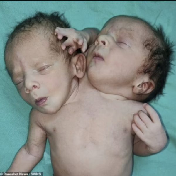 Baby is born with three arms, two heads and two hearts