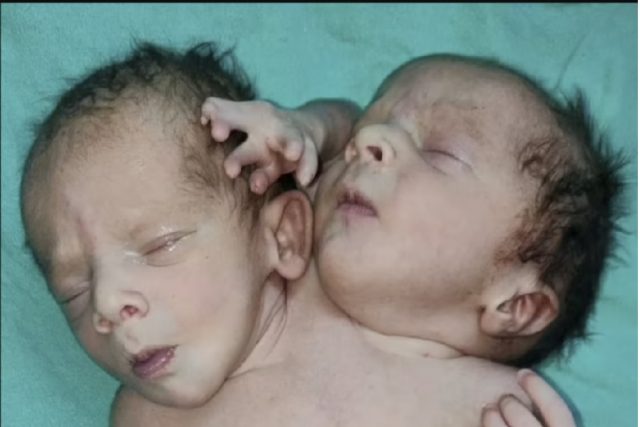 Baby is born with three arms, two heads and two hearts