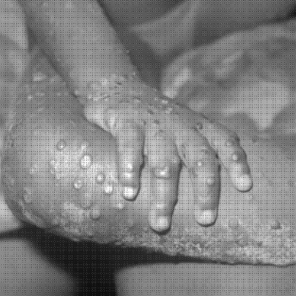 WHO declares monkeypox an global public health emergency