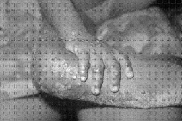 Monkeypox can be transmitted through sex – NCDC